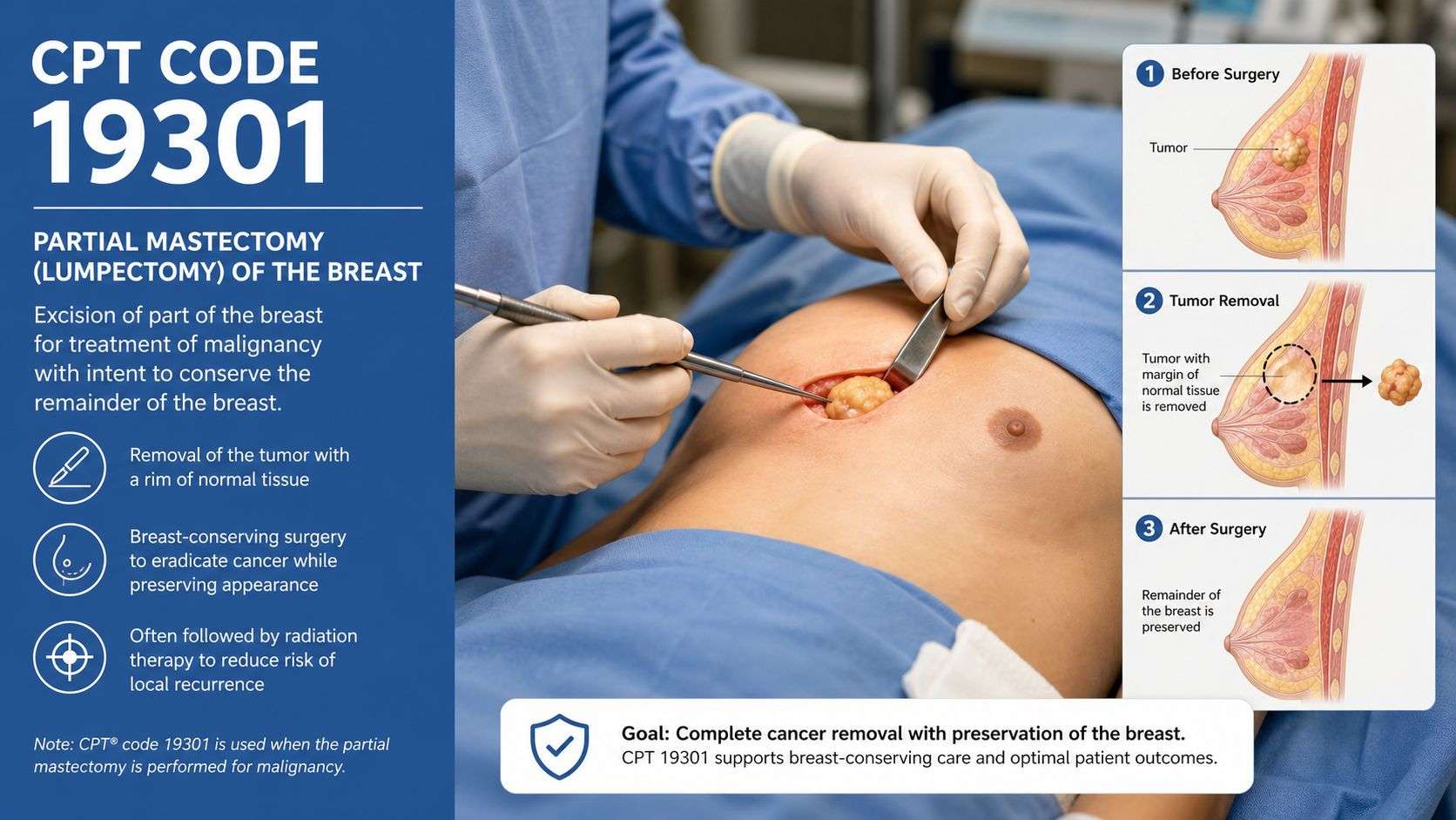 A medical infographic explaining CPT code 19301 for a partial mastectomy, or lumpectomy, to remove breast cancer.